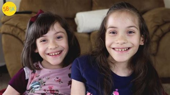 The Extraordinary Separation Of Faith Roberts, A Conjoined Twin